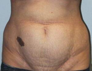 Tummy Tuck (Abdominoplasty)