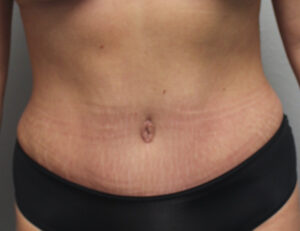 Tummy Tuck (Abdominoplasty)