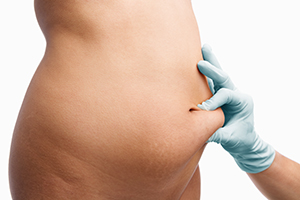 Female mid section pinched before liposuction