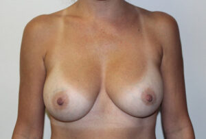 Breast Implant Removal Case 21365 Before Photo Breast Implant Removal