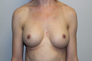 Breast Implant Removal Case 21366 Before Photo Breast Implant Removal