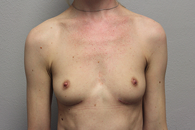 Breast Implant Removal