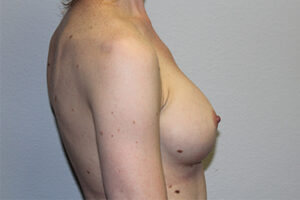 Breast Implant Removal Case 21366 Before Photo Breast Implant Removal