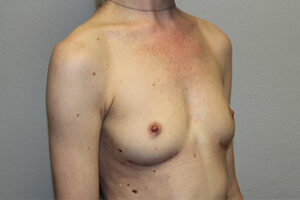 Breast Implant Removal Case 21366 After Photo Breast Implant Removal