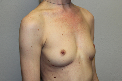 Breast Implant Removal