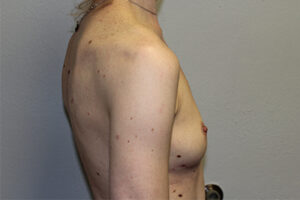 Breast Implant Removal Case 21366 After Photo Breast Implant Removal