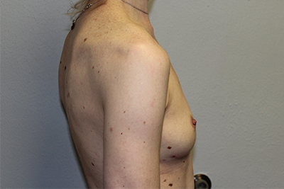 Breast Implant Removal