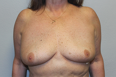 Breast Implant Removal