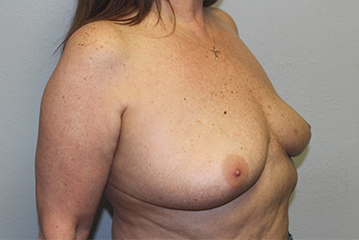 Breast Implant Removal