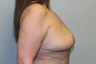Breast Implant Removal