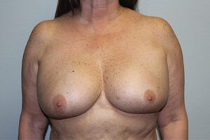 Breast Implant Removal Case 21367 Before Photo Breast Implant Removal