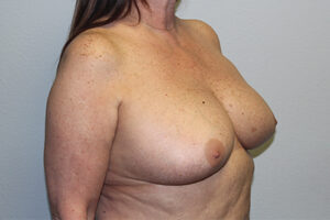 Breast Implant Removal Case 21367 Before Photo Breast Implant Removal