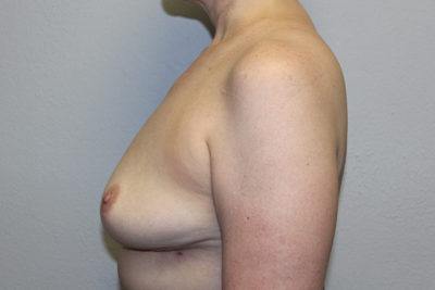 Breast Implant Removal