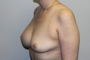 Breast Implant Removal Case 21368 Before Photo Breast Implant Removal