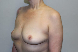 Breast Implant Removal Case 21368 After Photo Breast Implant Removal