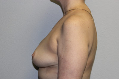 Breast Implant Removal