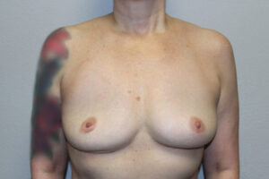 Breast Implant Removal Case 21368 After Photo Breast Implant Removal