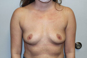 Breast Implant Removal Case 21369 After Photo Breast Implant Removal