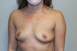 Breast Implant Removal Case 21369 After Photo Breast Implant Removal