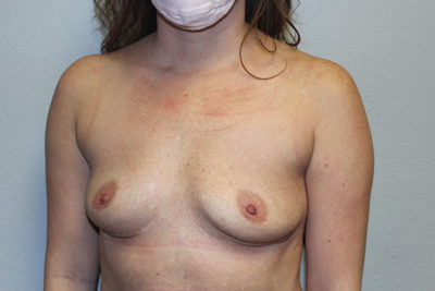 Breast Implant Removal