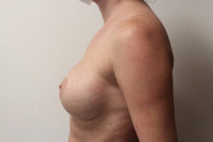 Breast Implant Removal Case 21369 Before Photo Breast Implant Removal