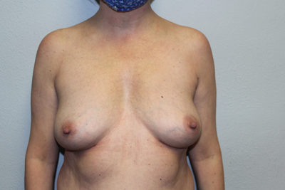 Breast Implant Removal