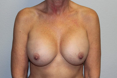 Breast Implant Removal