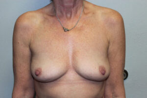 Breast Implant Removal Case 21371 After Photo Breast Implant Removal