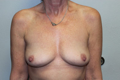 Breast Implant Removal