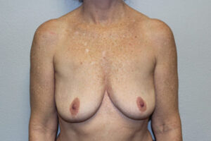 Breast Implant Removal
