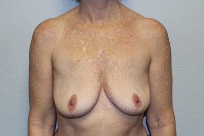 Breast Implant Removal