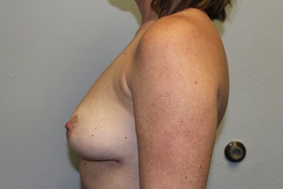 Breast Implant Removal