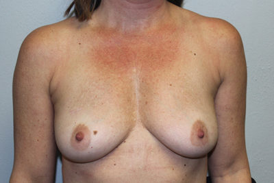 Breast Implant Removal