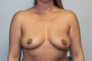 Breast Implant Removal Case 21374 After Photo Breast Implant Removal