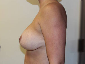 Breast Implant Removal Case 21375 Before Photo Breast Implant Removal