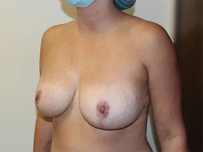 Breast Implant Removal