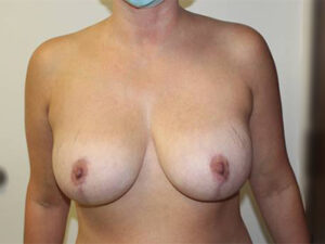 Breast Implant Removal Case 21375 Before Photo Breast Implant Removal