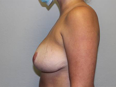 Breast Implant Removal