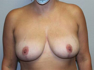 Breast Implant Removal Case 21375 After Photo Breast Implant Removal