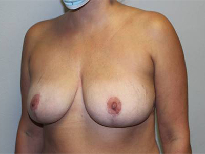 Breast Implant Removal