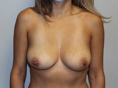 Breast Implant Removal