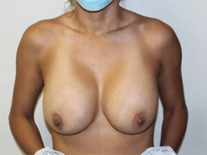 Breast Implant Removal Case 21376 Before Photo Breast Implant Removal