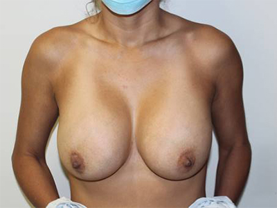 Breast Implant Removal
