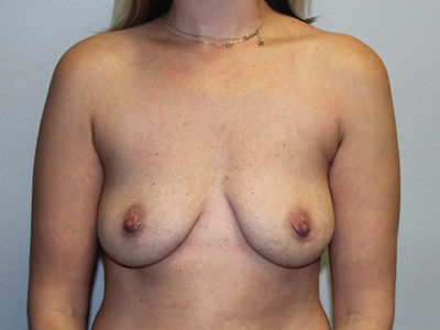 Breast Implant Removal