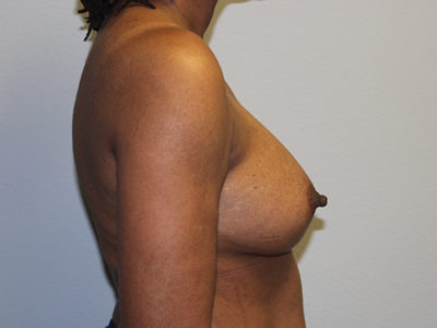 Breast Implant Removal