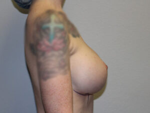 Breast Implant Removal Case 21379 Before Photo Breast Implant Removal