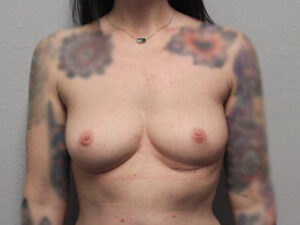 Breast Implant Removal Case 21379 After Photo Breast Implant Removal