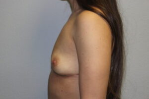 Breast Implant Removal Case 21381 After Photo Breast Implant Removal