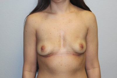 Breast Implant Removal