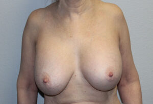 Breast Implant Removal